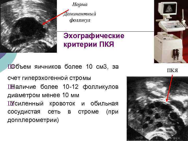  Норма Доминантный фолликул Эхографические критерии ПКЯ Ш Объем яичников более 10 см 3,