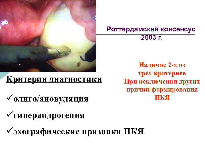  Роттердамский консенсус 2003 г. Наличие 2 -х из трех критериев Критерии диагностики При