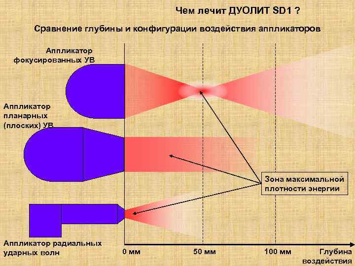 Чем лечит ДУОЛИТ SD 1 ? Сравнение глубины и конфигурации воздействия аппликаторов Аппликатор фокусированных