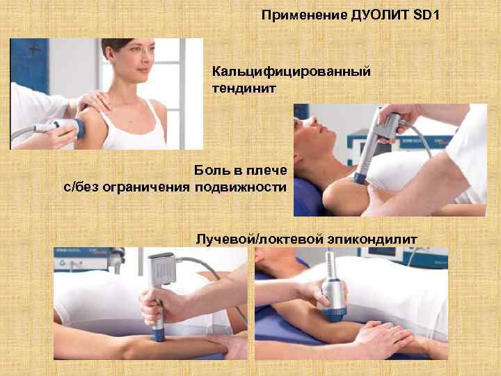 Применение ДУОЛИТ SD 1 Кальцифицированный тендинит Боль в плече с/без ограничения подвижности Лучевой/локтевой эпикондилит