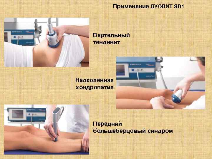 Применение ДУОЛИТ SD 1 Вертельный тендинит Надколенная хондропатия Передний большеберцовый синдром 