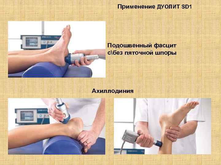 Применение ДУОЛИТ SD 1 Подошвенный фасцит сбез пяточной шпоры Ахиллодиния 
