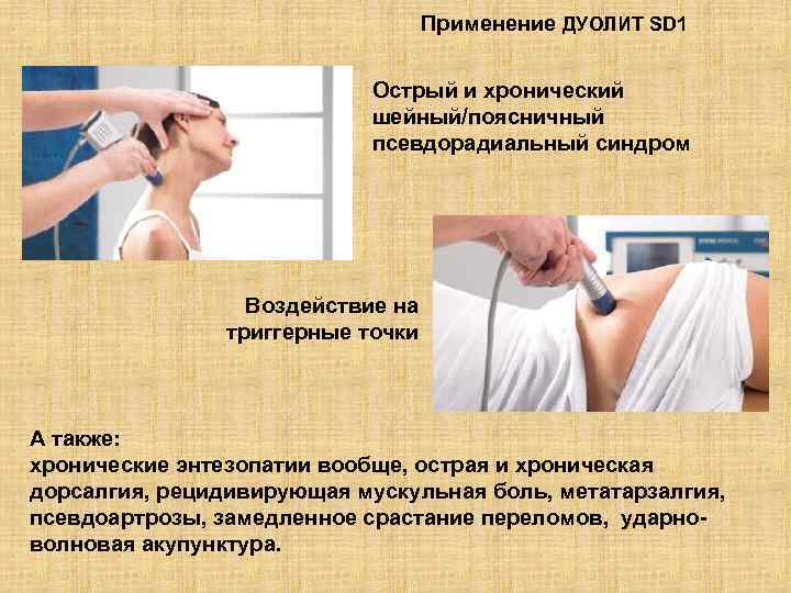Применение ДУОЛИТ SD 1 Острый и хронический шейный/поясничный псевдорадиальный синдром Воздействие на триггерные точки