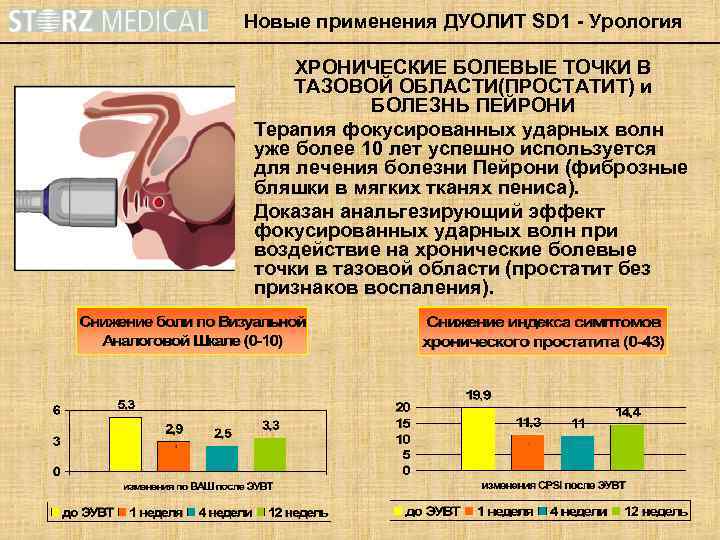 Новые применения ДУОЛИТ SD 1 - Урология ХРОНИЧЕСКИЕ БОЛЕВЫЕ ТОЧКИ В ТАЗОВОЙ ОБЛАСТИ(ПРОСТАТИТ) и