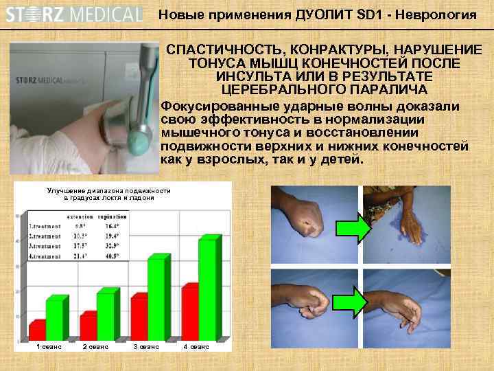 Новые применения ДУОЛИТ SD 1 - Неврология СПАСТИЧНОСТЬ, КОНРАКТУРЫ, НАРУШЕНИЕ ТОНУСА МЫШЦ КОНЕЧНОСТЕЙ ПОСЛЕ