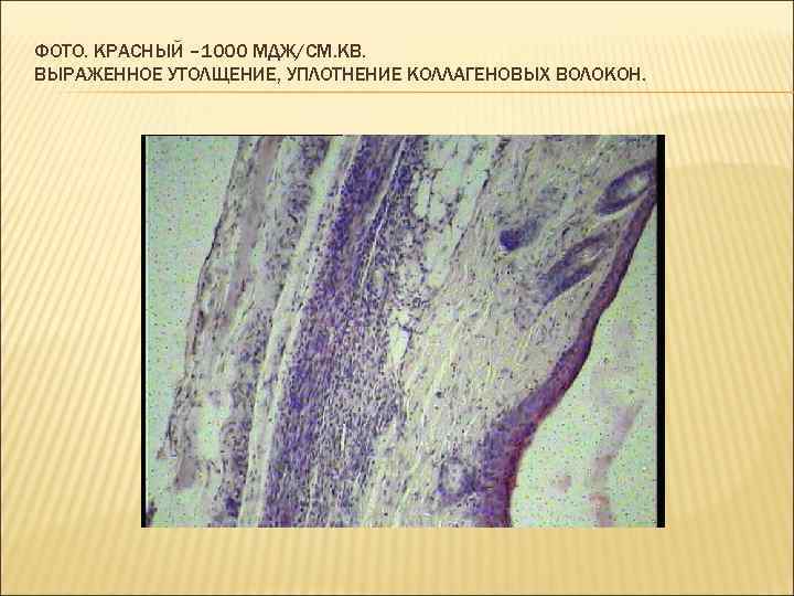 ФОТО. КРАСНЫЙ – 1000 МДЖ/СМ. КВ. ВЫРАЖЕННОЕ УТОЛЩЕНИЕ, УПЛОТНЕНИЕ КОЛЛАГЕНОВЫХ ВОЛОКОН. 