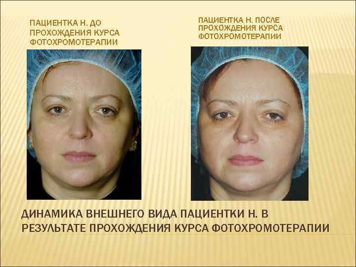 ПАЦИЕНТКА Н. ДО ПРОХОЖДЕНИЯ КУРСА ФОТОХРОМОТЕРАПИИ ПАЦИЕНТКА Н. ПОСЛЕ ПРОХОЖДЕНИЯ КУРСА ФОТОХРОМОТЕРАПИИ ДИНАМИКА ВНЕШНЕГО
