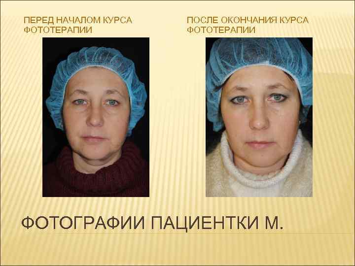 ПЕРЕД НАЧАЛОМ КУРСА ФОТОТЕРАПИИ ПОСЛЕ ОКОНЧАНИЯ КУРСА ФОТОТЕРАПИИ ФОТОГРАФИИ ПАЦИЕНТКИ М. 