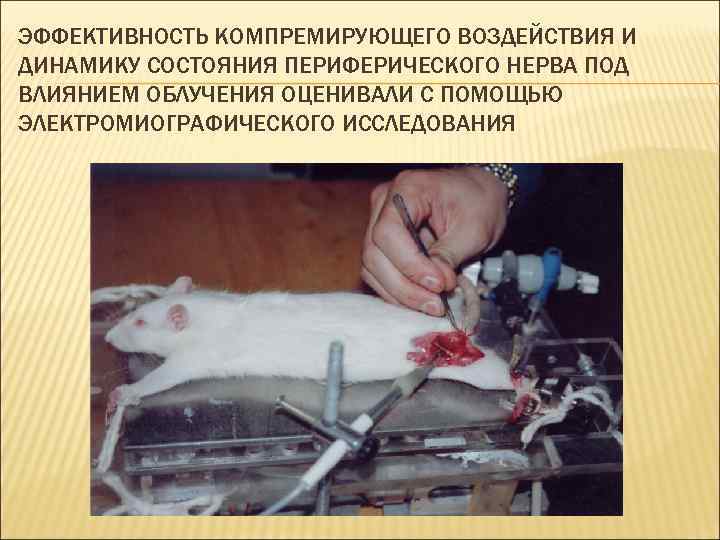 ЭФФЕКТИВНОСТЬ КОМПРЕМИРУЮЩЕГО ВОЗДЕЙСТВИЯ И ДИНАМИКУ СОСТОЯНИЯ ПЕРИФЕРИЧЕСКОГО НЕРВА ПОД ВЛИЯНИЕМ ОБЛУЧЕНИЯ ОЦЕНИВАЛИ С ПОМОЩЬЮ