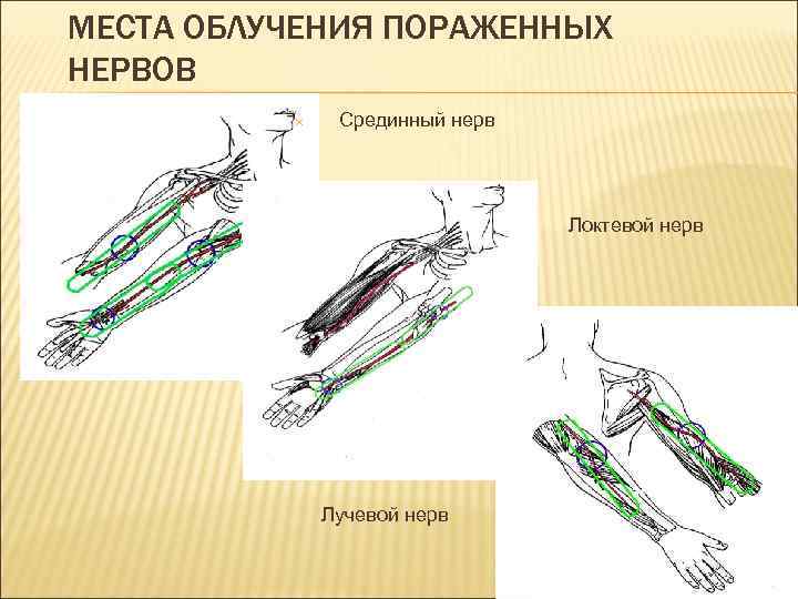 МЕСТА ОБЛУЧЕНИЯ ПОРАЖЕННЫХ НЕРВОВ Срединный нерв Локтевой нерв Лучевой нерв 55 