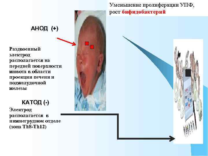 Уменьшение пролиферации УПФ, рост бифидобактерий АНОД (+) Раздвоенный электрод располагается на передней поверхности живота