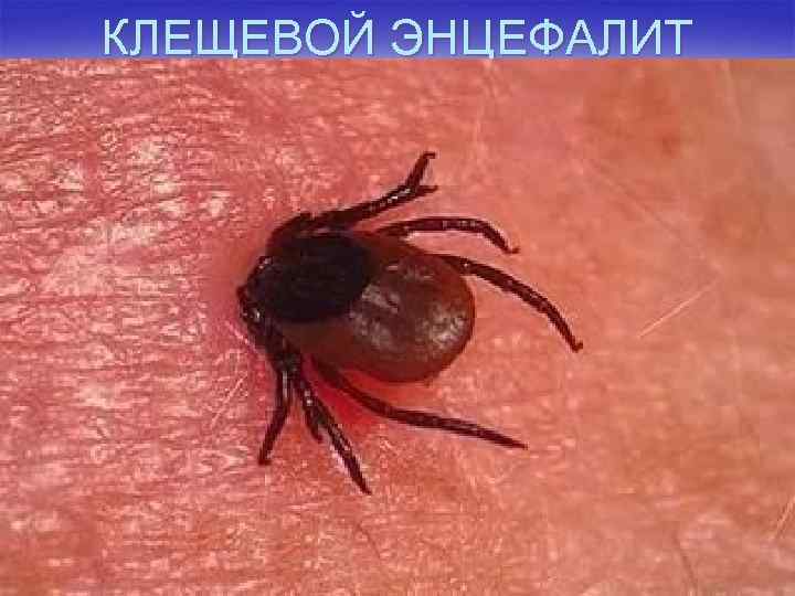 КЛЕЩЕВОЙ ЭНЦЕФАЛИТ 