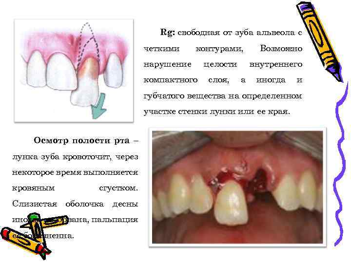 Rg: свободная от зуба альвеола с четкими контурами, нарушение компактного целости слоя, Возможно внутреннего