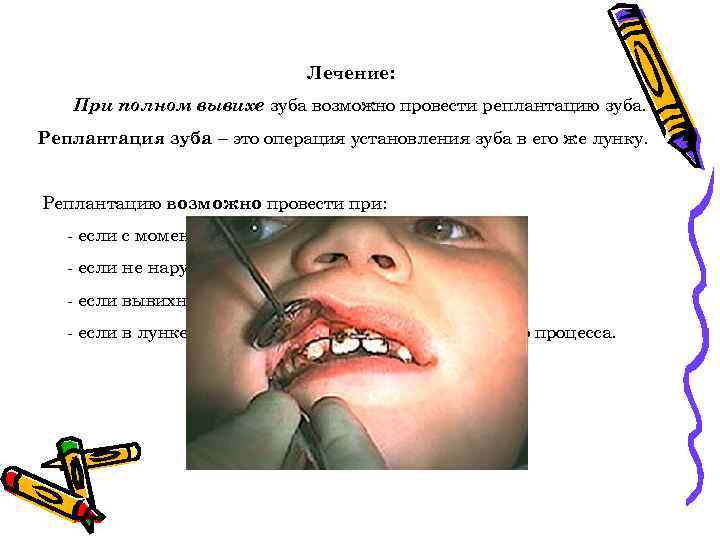 Лечение: При полном вывихе зуба возможно провести реплантацию зуба. Реплантация зуба – это операция