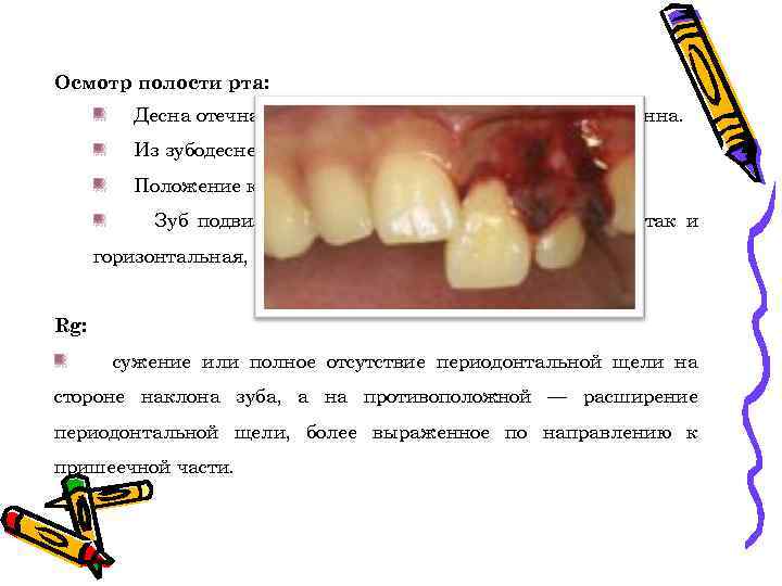 Осмотр полости рта: Десна отечна, гиперемирована, пальпация ее болезненна. Из зубодесневой щели может выделяться