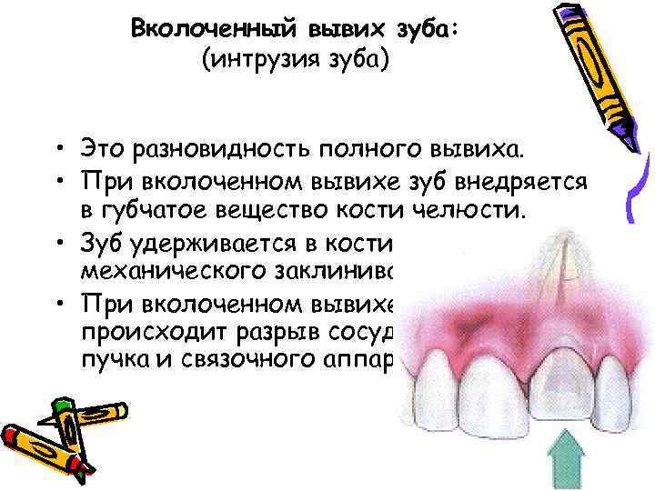Вколоченный вывих зуба: (интрузия зуба) • Это разновидность полного вывиха. • При вколоченном вывихе