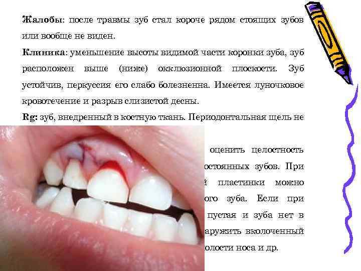 Жалобы: после травмы зуб стал короче рядом стоящих зубов или вообще не виден. Клиника: