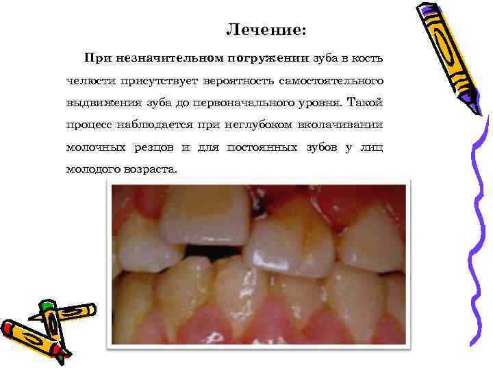 Лечение: При незначительном погружении зуба в кость челюсти присутствует вероятность самостоятельного выдвижения зуба до