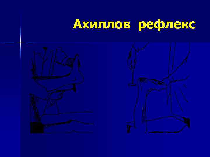 Ахиллов рефлекс 