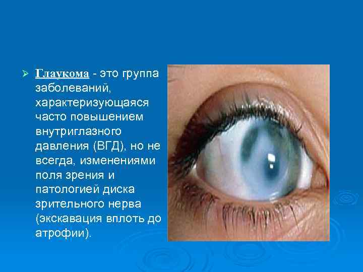 Ø Глаукома - это группа заболеваний, характеризующаяся часто повышением внутриглазного давления (ВГД), но не