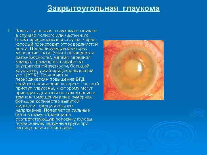 Закрытоугольная глаукома Ø Закрытоугольная глаукома возникает в случаях полного или частичного блока иридокорнеальногоугла, через