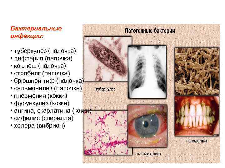 Бактериальные инфекции: • туберкулез (палочка) • дифтерия (палочка) • коклюш (палочка) • столбняк (палочка)
