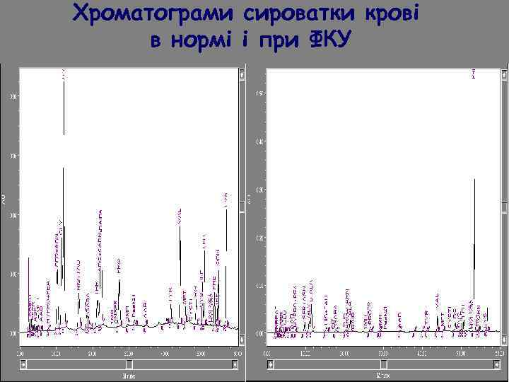 Хроматограми сироватки крові в нормі i при ФКУ 