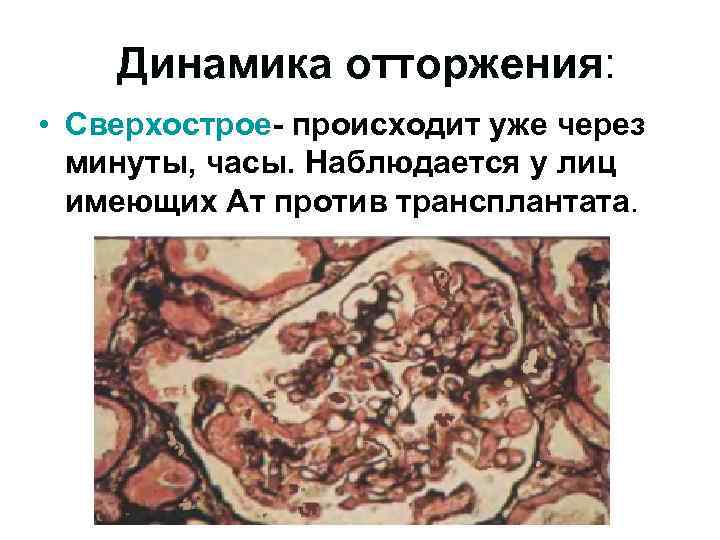 Динамика отторжения: • Сверхострое- происходит уже через минуты, часы. Наблюдается у лиц имеющих Ат