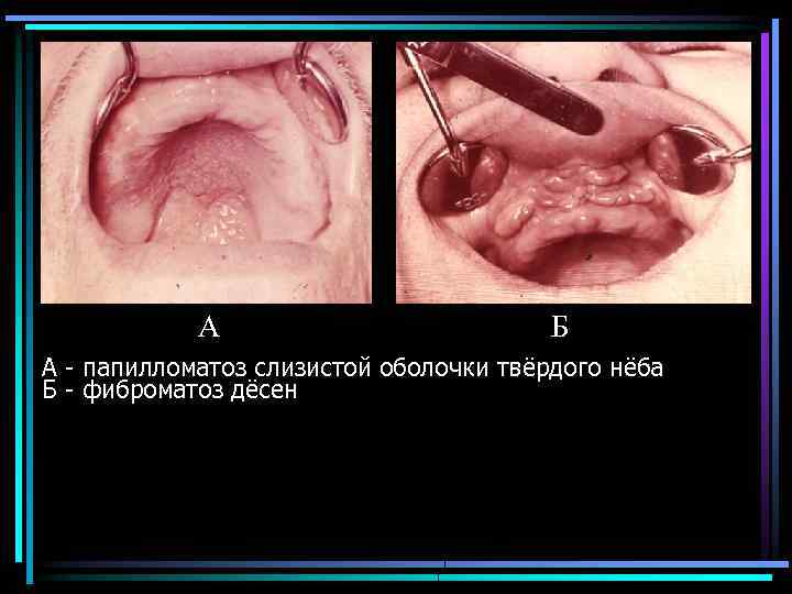 А Б А папилломатоз слизистой оболочки твёрдого нёба Б фиброматоз дёсен 