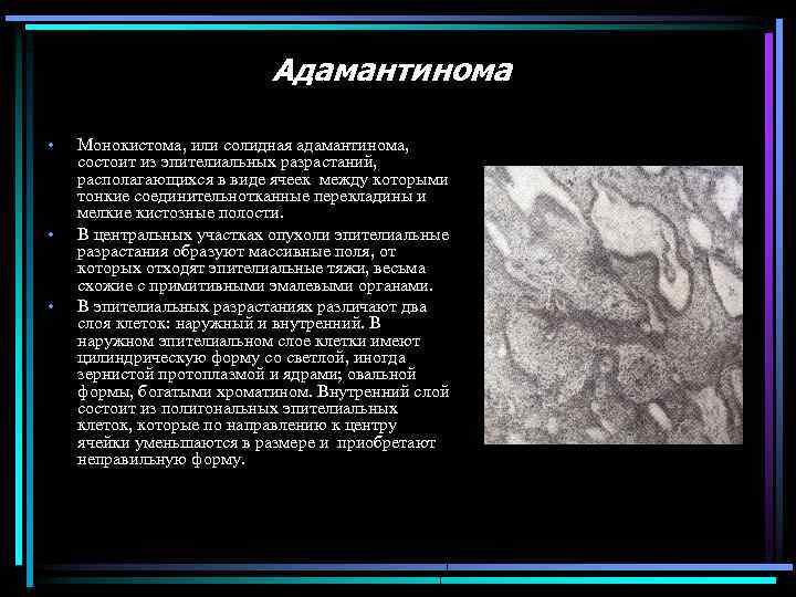 Адамантинома • • • Монокистома, или солидная адамантинома, состоит из эпителиальных разрастаний, располагающихся в