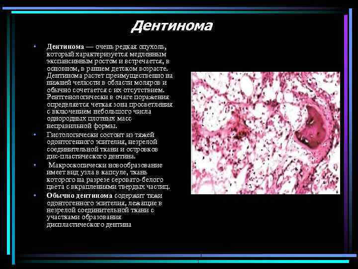Дентинома • • Дентинома — очень редкая опухоль, который характеризуется медленным экспансивным ростом и