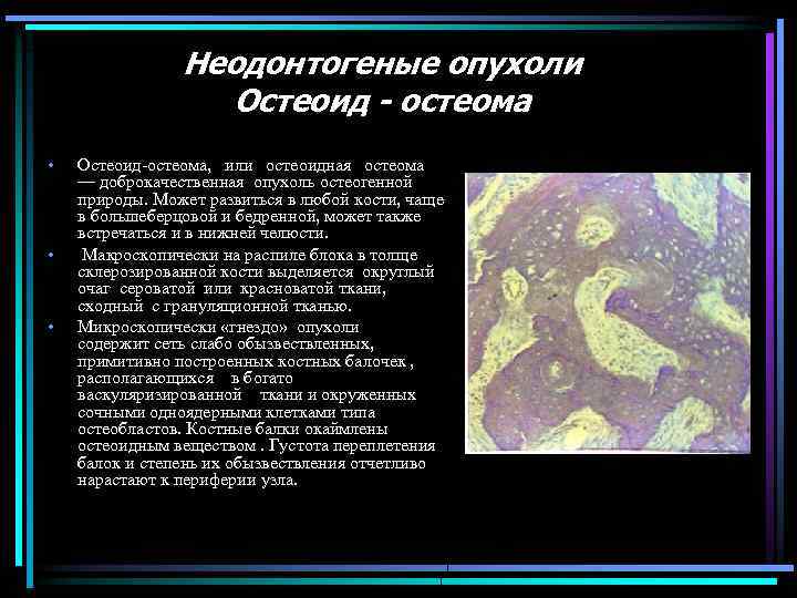Неодонтогеные опухоли Остеоид - остеома • • • Остеоид остеома, или остеоидная остеома —