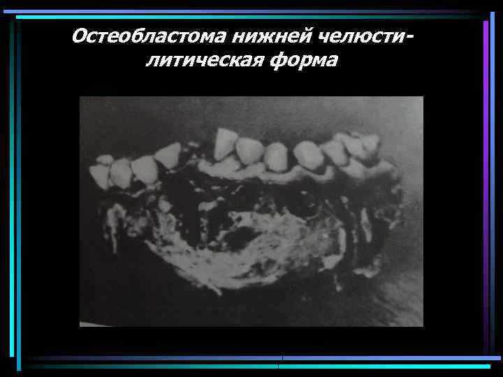 Остеобластома нижней челюстилитическая форма 