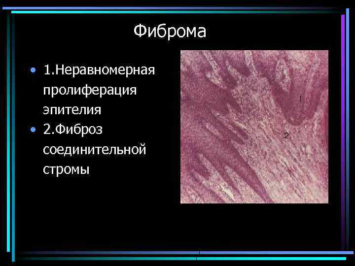 Фиброма • 1. Неравномерная пролиферация эпителия • 2. Фиброз соединительной стромы 