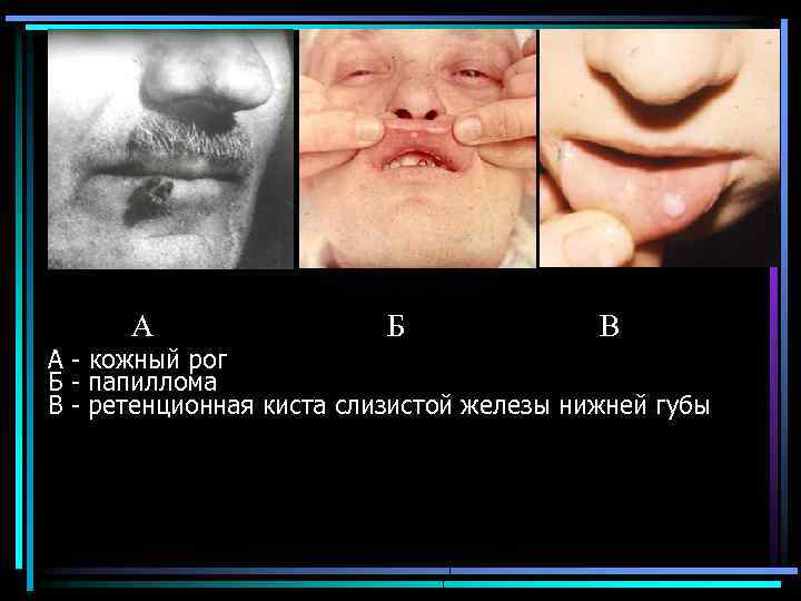А Б В А кожный рог Б папиллома В ретенционная киста слизистой железы нижней