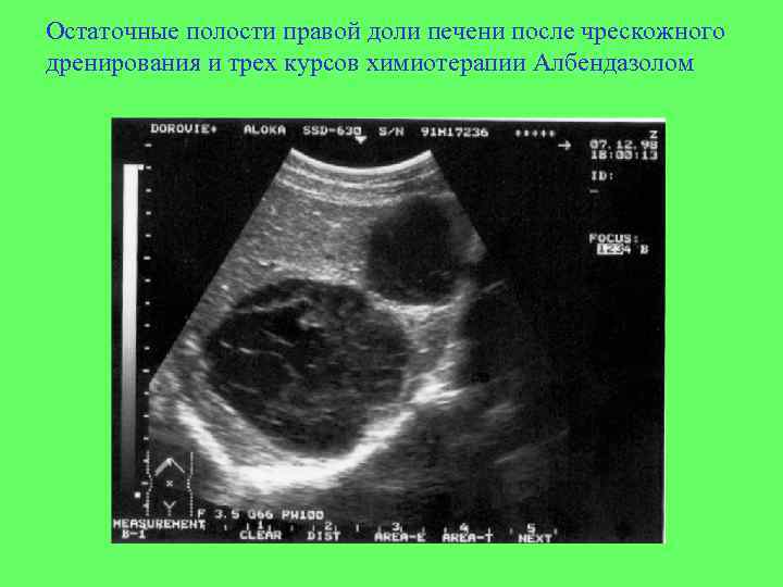 Остаточные полости правой доли печени после чрескожного дренирования и трех курсов химиотерапии Албендазолом 