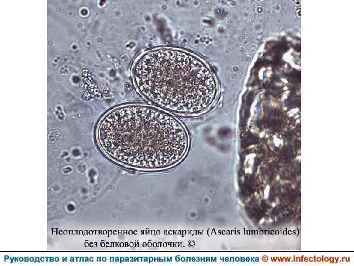 Растительная клетчатка непереваримая. Микроскопия мокроты при аскаридозе. Растительная клетчатка в Кале под микроскопом. Клетчатка в Кале под микроскопом. Растительные клетки в Кале.