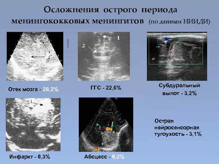Осложнения острого периода менингококковых менингитов (по данным НИИДИ) Отек мозга - 28, 2% ГГС