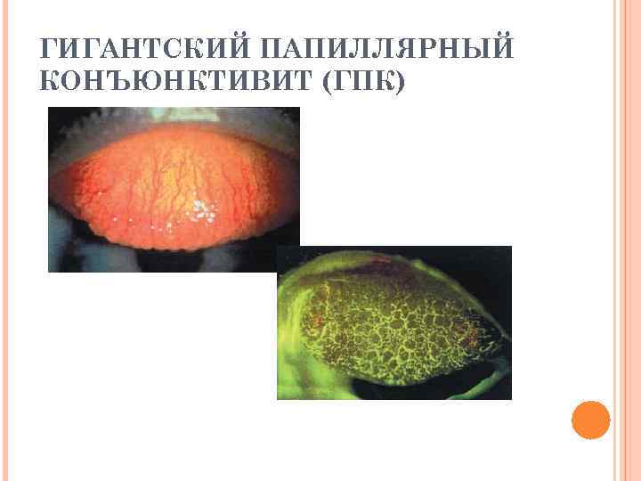 ГИГАНТСКИЙ ПАПИЛЛЯРНЫЙ КОНЪЮНКТИВИТ (ГПК) 