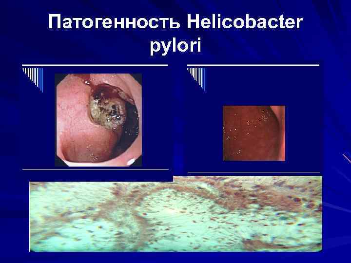 Патогенность Helicobacter pylori 