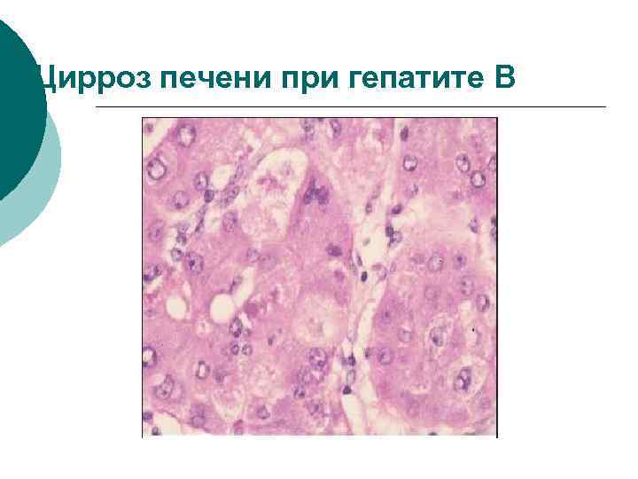 Цирроз печени при гепатите B 