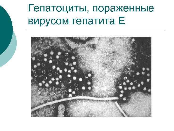 Гепатоциты, пораженные вирусом гепатита E 