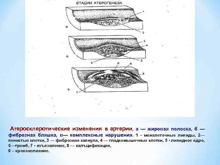 Атеросклеротические изменения в артерии, а — жировая полоска, б — фиброзная бляшка, в— комплексные