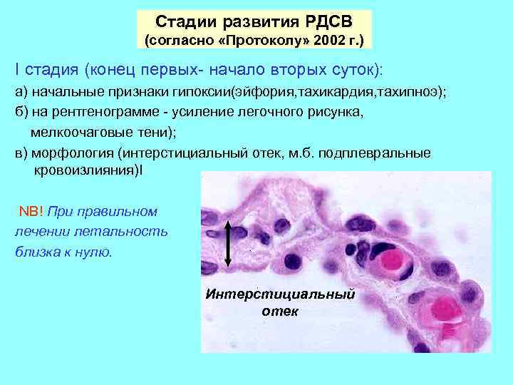 Стадии развития РДСВ (согласно «Протоколу» 2002 г. ) I стадия (конец первых- начало вторых