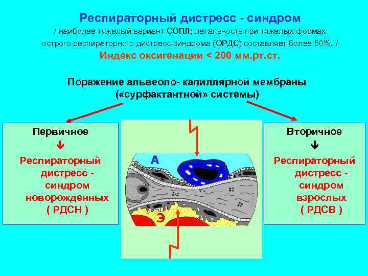 Респираторный дистресс - синдром / наиболее тяжелый вариант СОПЛ; летальность при тяжелых формах острого