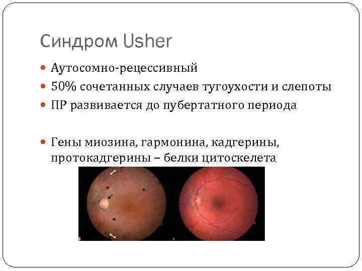 Синдром Usher Аутосомно-рецессивный 50% сочетанных случаев тугоухости и слепоты ПР развивается до пубертатного периода