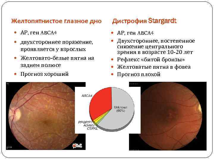 Желтопятнистое глазное дно Дистрофия Stargardt АР, ген ABCA 4 двухстороннее поражение, Двухстороннее, постепенное проявляется