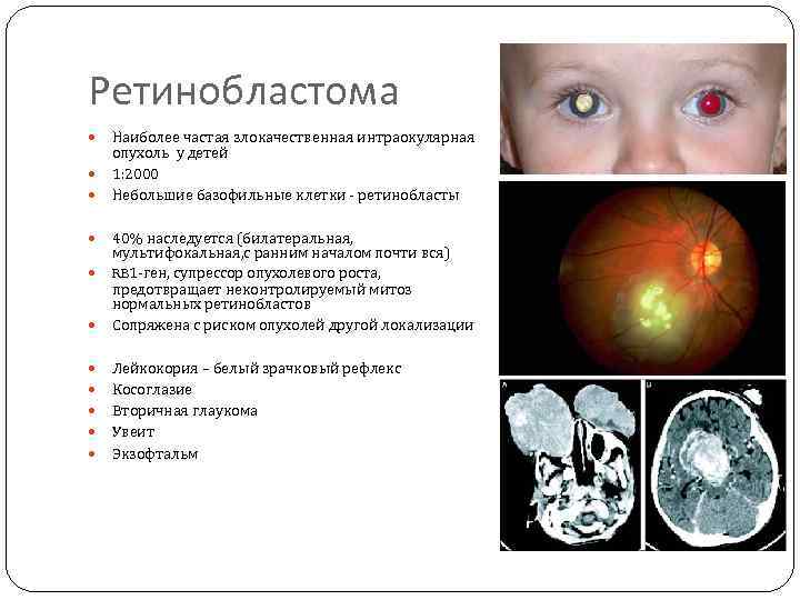 Ретинобластома Наиболее частая злокачественная интраокулярная опухоль у детей 1: 2000 Небольшие базофильные клетки -