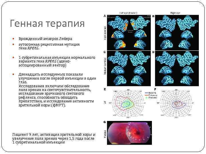 Синдром лебера тип наследования. Оптическая нейропатия Лебера. Генетическая терапия.