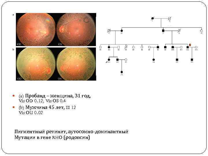  (a) Пробанд – женщина, 31 год, Vis OD 0. 12, Vis OS 0.